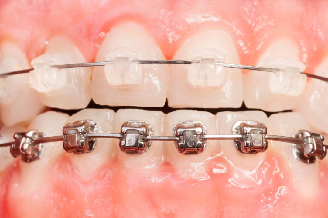 100 Paquetes De Ortodoncia Dental OC MIM Brackets MetálicosTirantes Mini Mbt 022 345 Ganchos 1415